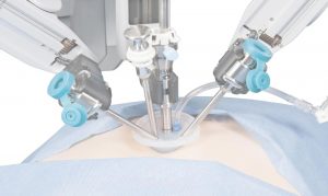 böbrek kanserinde robotik cerrahi